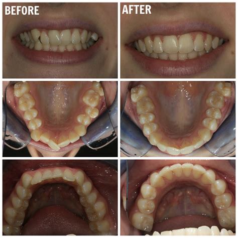 fastbraces reviews